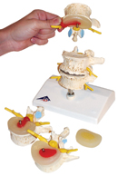 A795: Stages of disc prolapse and vertebral degeneration