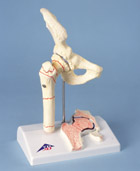 A88: Femoral Fracture and Hip Osteoarthritis