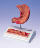 K17: Stomach with Ulcers