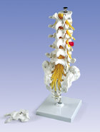 A76/5: Lumbar Spinal Column with dorso-lateral prolapsed intervertebral disc