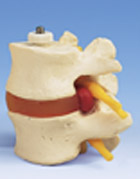 A76/9: 2 Lumbar Vertebrae with prolapsed disc, flexibly mounted