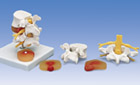 A76: Lumbar Spinal Column with prolapsed intervertebral disc