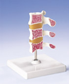 A78: Deluxe Osteoporosis Model (3 Vertebrae)