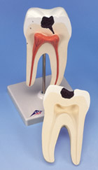 D10/4: Lower Twin-Root Molar showing caries attack, 2-part
