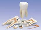 D15: Giant Molar with Dental Caries, 15 times life-size, 6-part