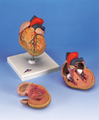 G04: Classic Heart with Left Ventricular Hypertrophy (LVH), 2-part
