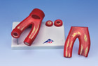 G40: Arteriosclerosis Model, with cross section of artery, 2-part