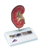 K29: Kidney Stone Model