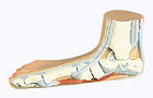 M31: Flat Foot (Pes Planus)