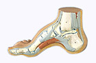 M32: Hollow Foot (Pes Cavus)